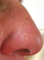 aracnid